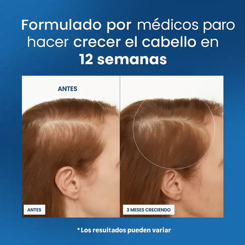 Serum BodyWise® - Crecimiento Capilar Femenino